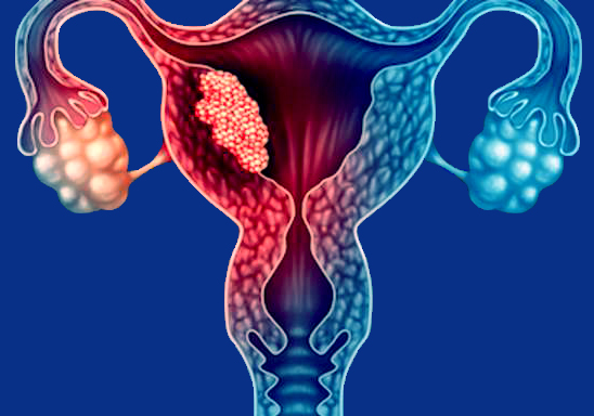 Endometrial cancer